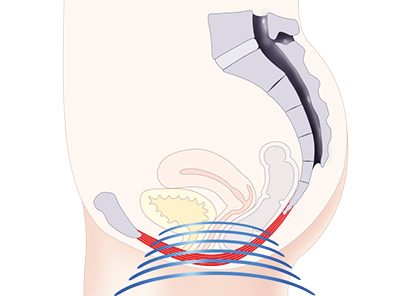 Pelvic Floor Care for females diagram cross section of how Emsella works.